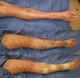 Intraoperative surgical planning lymphovenous anastomosis. Source: Dr. Ketan M. Patel. 