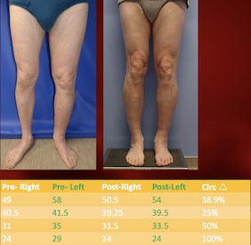 Pre and post-operative images. Lymphovenous anastomosis. Source: Dr. Ketan M. Patel. 