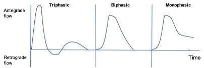 Peripheral artery waveforms: triphasic, biphasic and monophasic