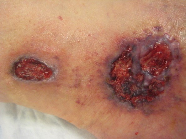 Ulcerative pyoderma gangrenosum (by Lebendiskaya, N. RN,BSN,CWOCN)