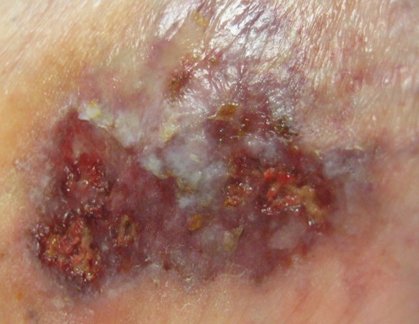 Ulcerative pyoderma gangrenosum, early lesion (by Lebendiskaya, N. RN,BSN,CWOCN)