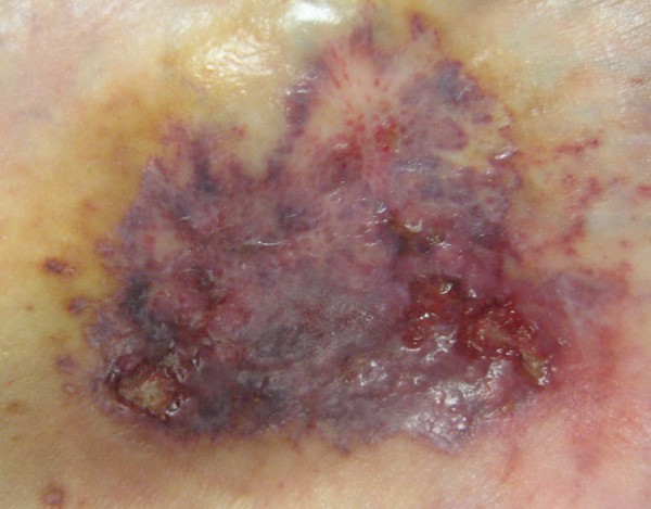 Ulcerative pyoderma gangrenosum in figure 3 progressing to ulcer (by Lebendiskaya, N. RN,BSN,CWOCN)