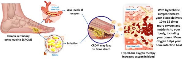 Effects of hyperbaric oxygen therapy on chronic refractory osteomyelitis