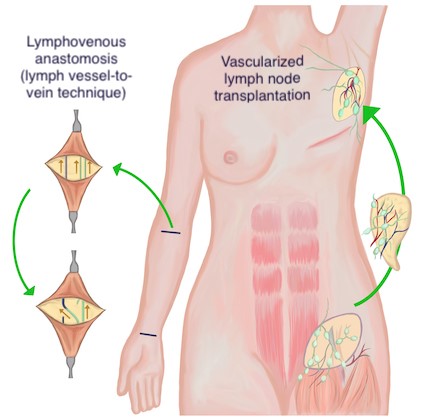 Lymphatic reconstruction techniques