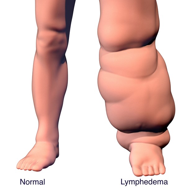 Normal leg and leg with lymphedema (fluid build up)
