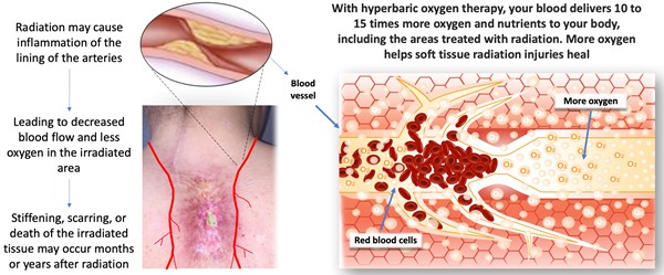 Effects of HBOT on soft tissue radiation necrosis. Picture by Wong A.K, M.D.