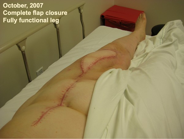 Soft tissue radionecrosis. Post  After HBOT and surgical wound coverage