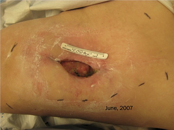 Soft tissue radionecrosis. Patient underwent HBOT for 2 months