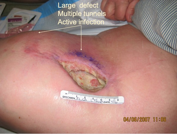 Soft tissue radionecrosis