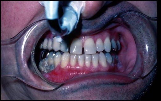  Mandibular osteoradionecrosis. Marx Stage I with exposed mandible.