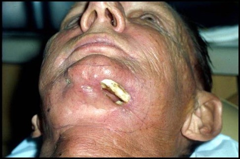 Mandibular osteoradionecrosis. Marx Stage III with orocutaneous fistula.