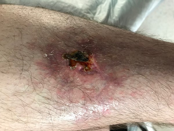 Necrotic tissue of the ulcer being removed 