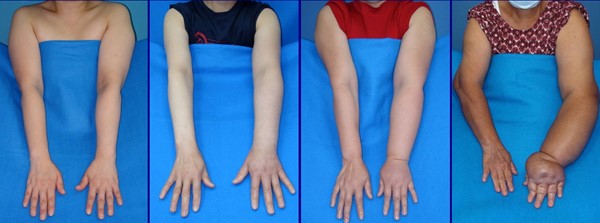 Lymphedema of the arms. DocHealer [CC BY-SA 4.0]