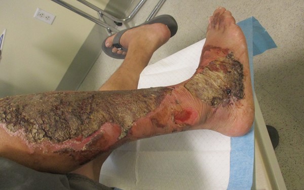  Right leg with partial thickness burn injury, covered with non-viable tissue. By Lebendiskaya N.