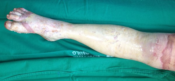 Full-thickness circumferential burns of right leg.