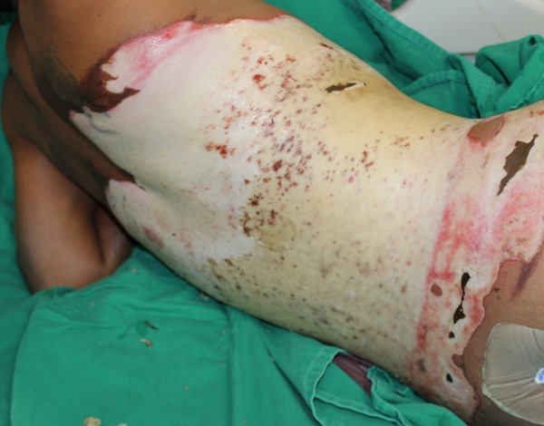 Full-thickness circumferential burn injury of the thoracic and abdominal regions 