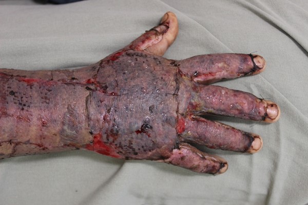 Sheet split-thickness skin grafts on right hand