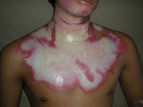 Deep partial thickness burn injury on face and neck 