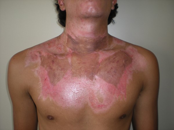 Deep partial thickness burn injury on face and neck 