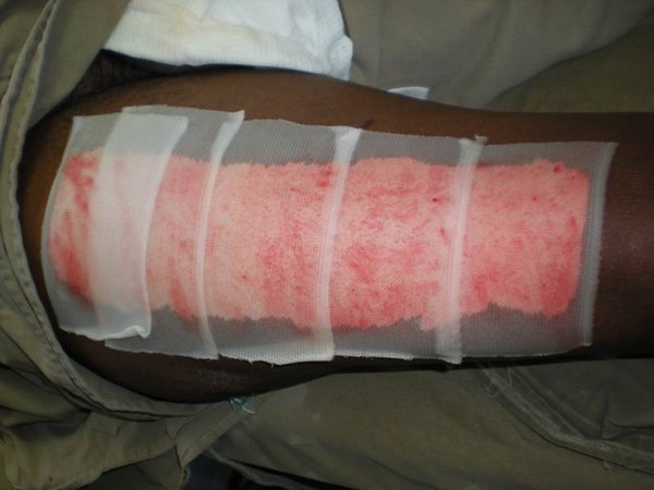 Split-thickness skin graft donor area, right thigh