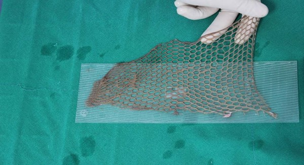 Appearance of a meshed skin graft