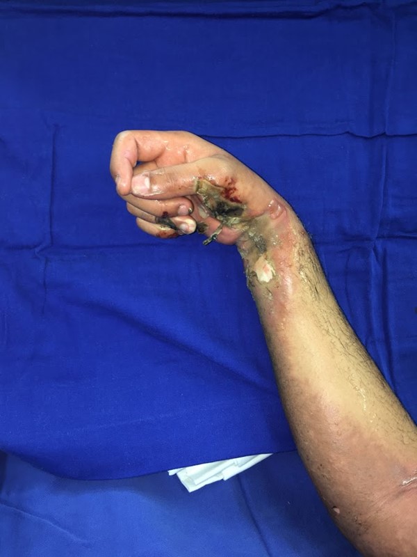 Full-thickness burn caused by high-voltage electricity on right hand
