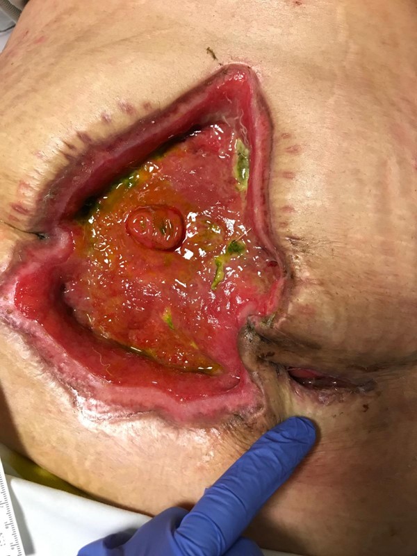 Enteroatmospheric fistula        