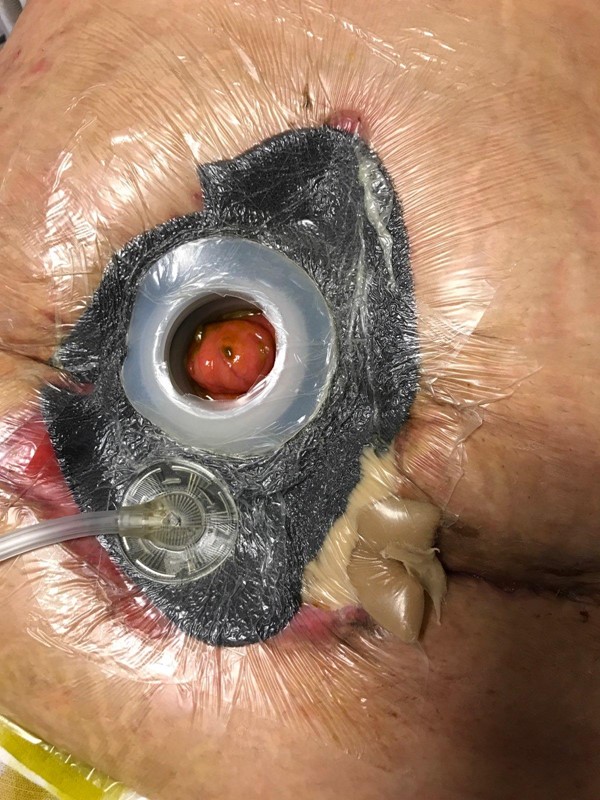 NPWT with fistula isolation device in place