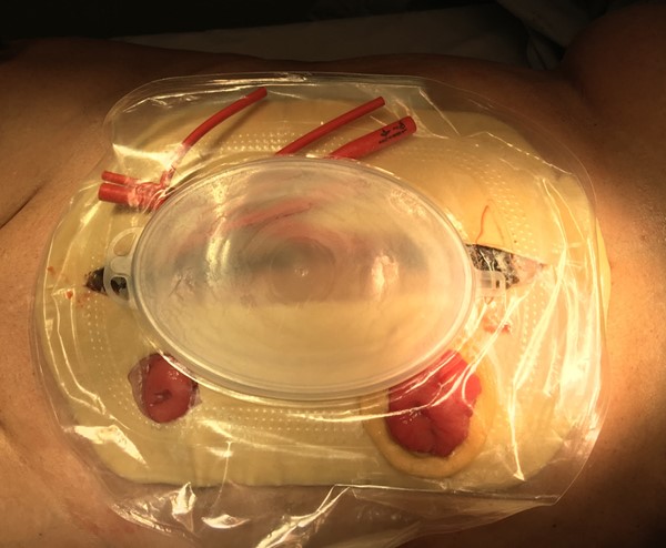 Wound manager with fenestrated catheter. By Kuplicki S. MSN, APRN