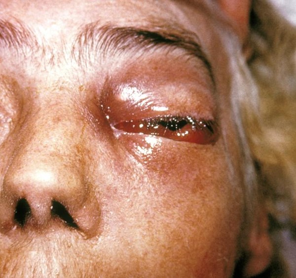 Periorbital fungal infection. By CDC/Dr. Thomas F. Sellers/Emory University Periorbital fungal infection