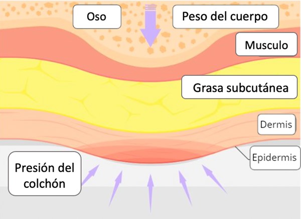 Causas de las úlceras/lesiones por presión 