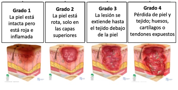 Clasificación de úlceras por presión 