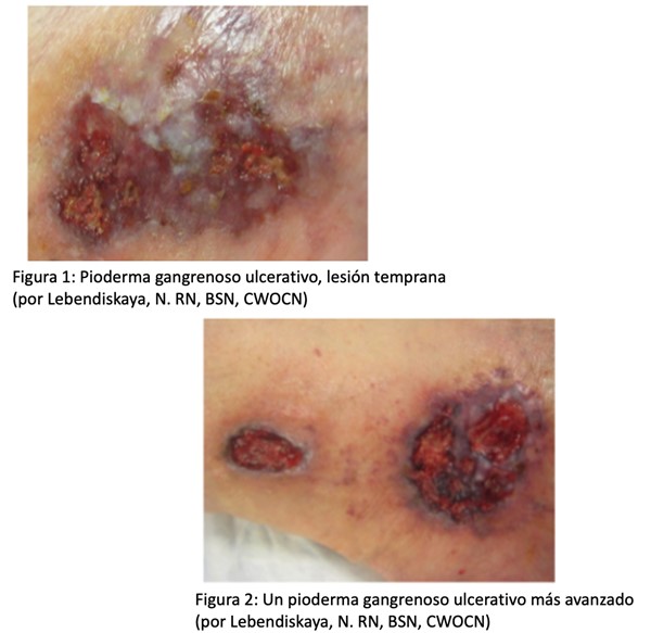 Pioderma gangrenoso ulcerativo