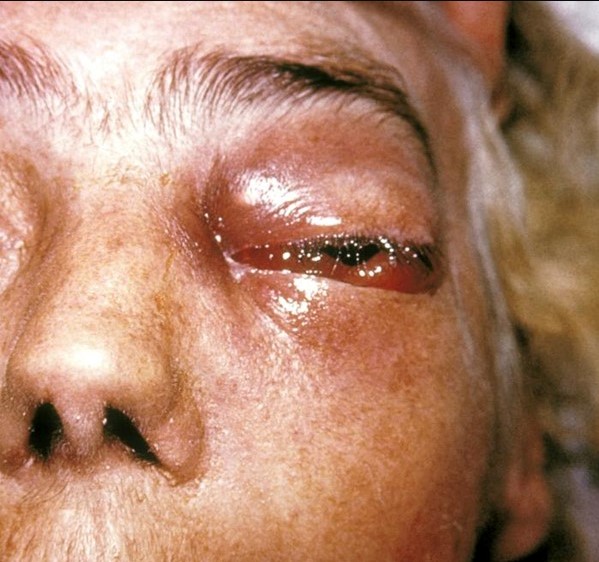 Periorbital fungal infection (mucormycosis).By CDC/Dr. Thomas F. Sellers/Emory University