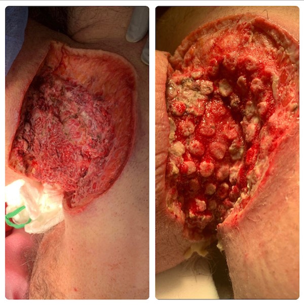 Left: Neck defect. Right: 2 weeks after NPWT