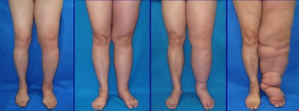 Linfedema de piernas