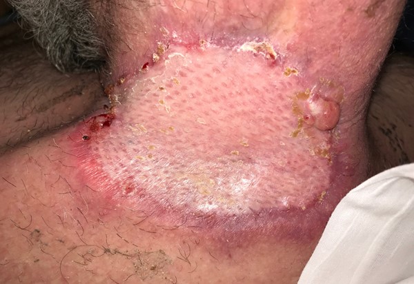 13 days post-op split thickness skin grafting 