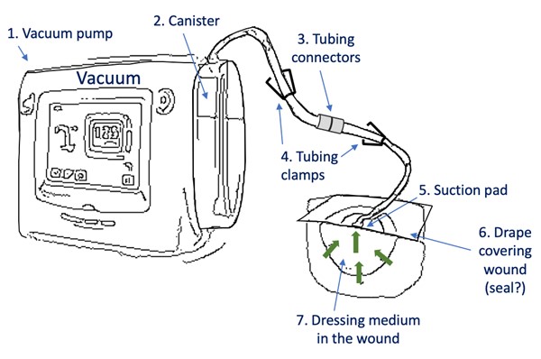 Troubleshooting NPWT - Systematic Assessment 