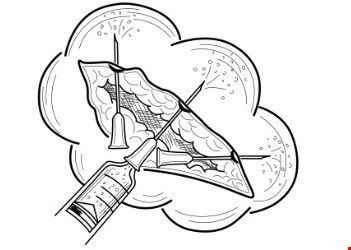 Direct infiltration.jpeg