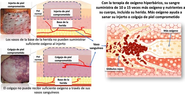 Efectos de la terapia de oxígeno hiperbárico en injertos y colgajos comprometidos