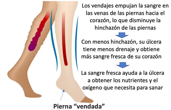 Terapia de compresión con vendaje o media