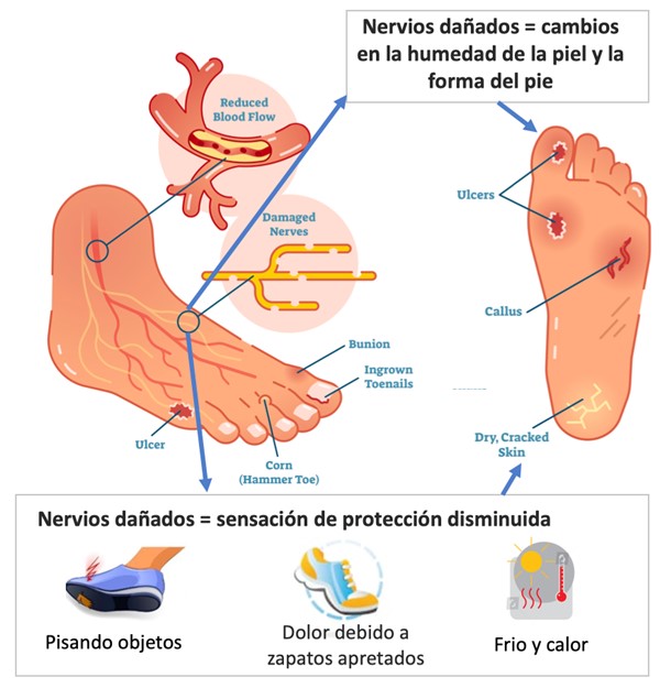 Causas de la úlcera del pie diabético