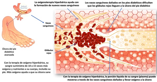 Efectos de la terapia de oxígeno hiperbárico en el pie diabético