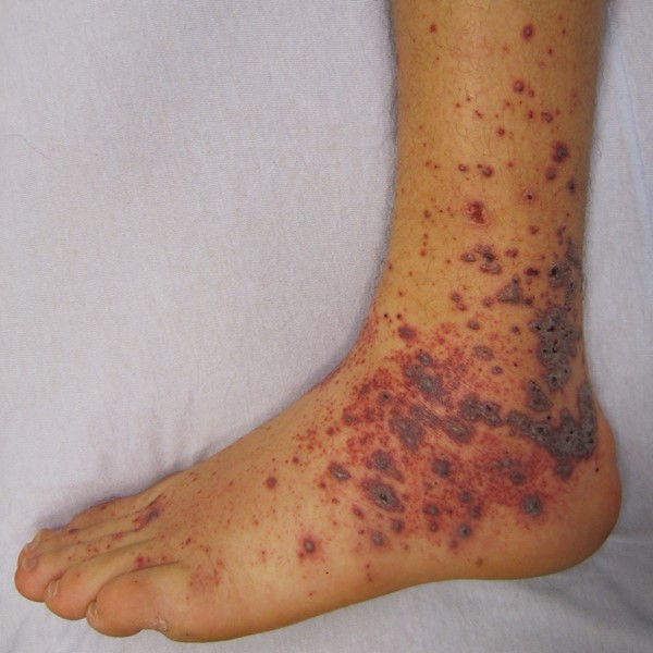 Drug-induced vasculitis.jpg