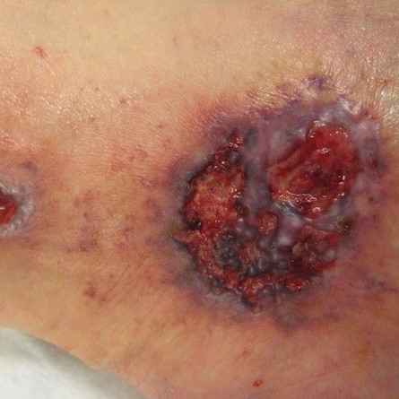 Pyoderma gangrenosum.jpg