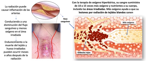 Efectos de la terapia de oxígeno hiperbárico en lesiones por radiación de tejidos blandos