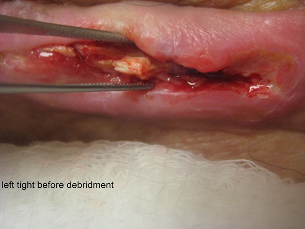 Calcium deposit on wound bed