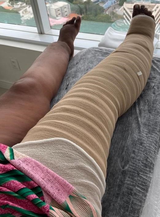  Multicomponent bandage system (tubular bandage, foam, short stretch) . By Feijoeiro F, PT