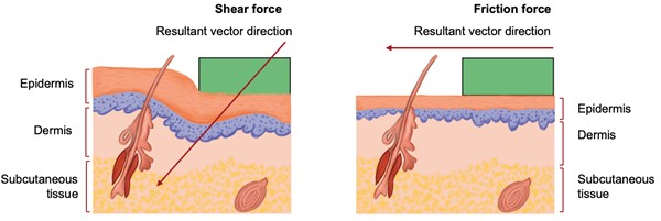 Mechanical forces involved in the pathophysiology of a skin tear