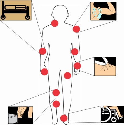 Most frequent locations of skin tears 